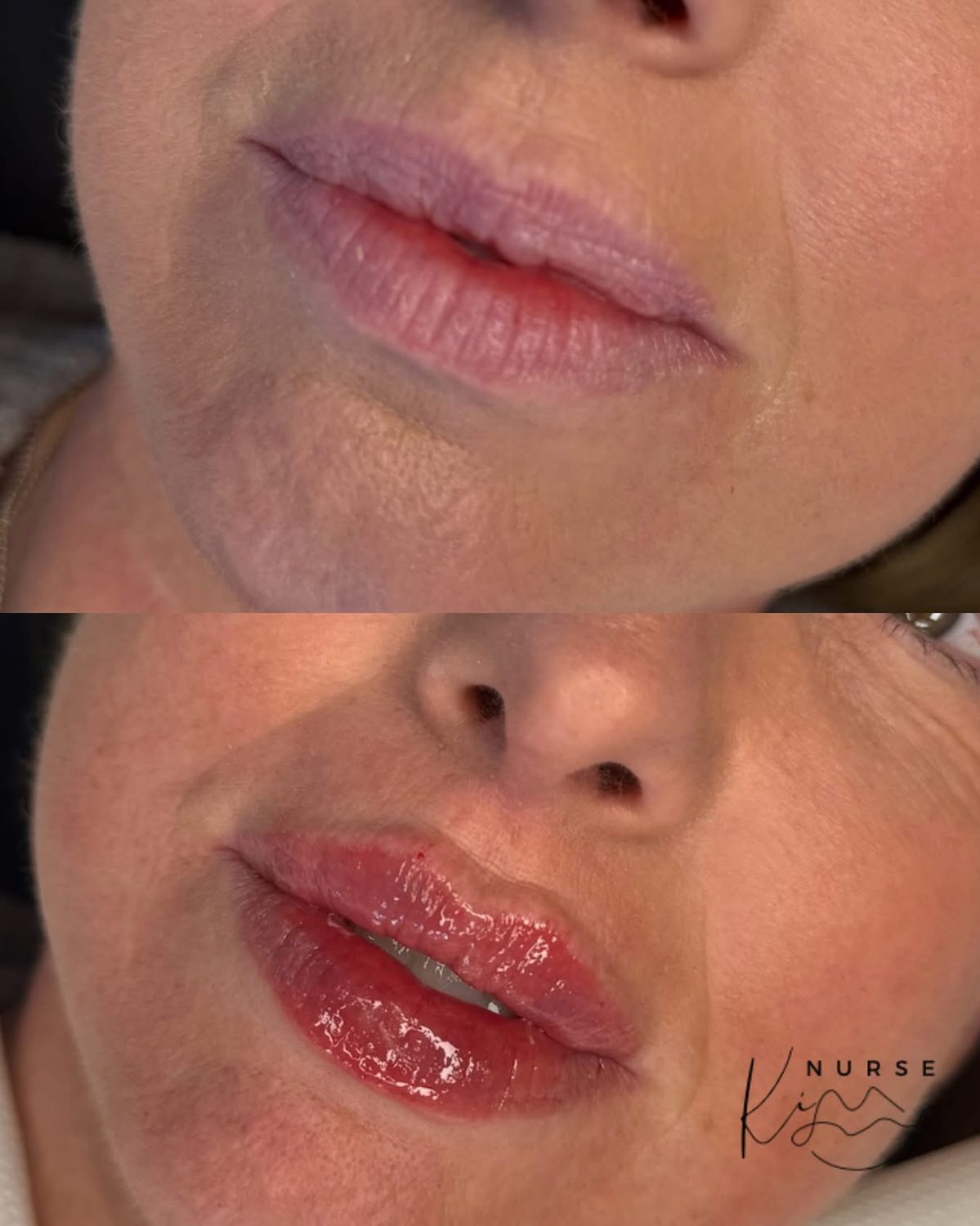 Lip Filler result