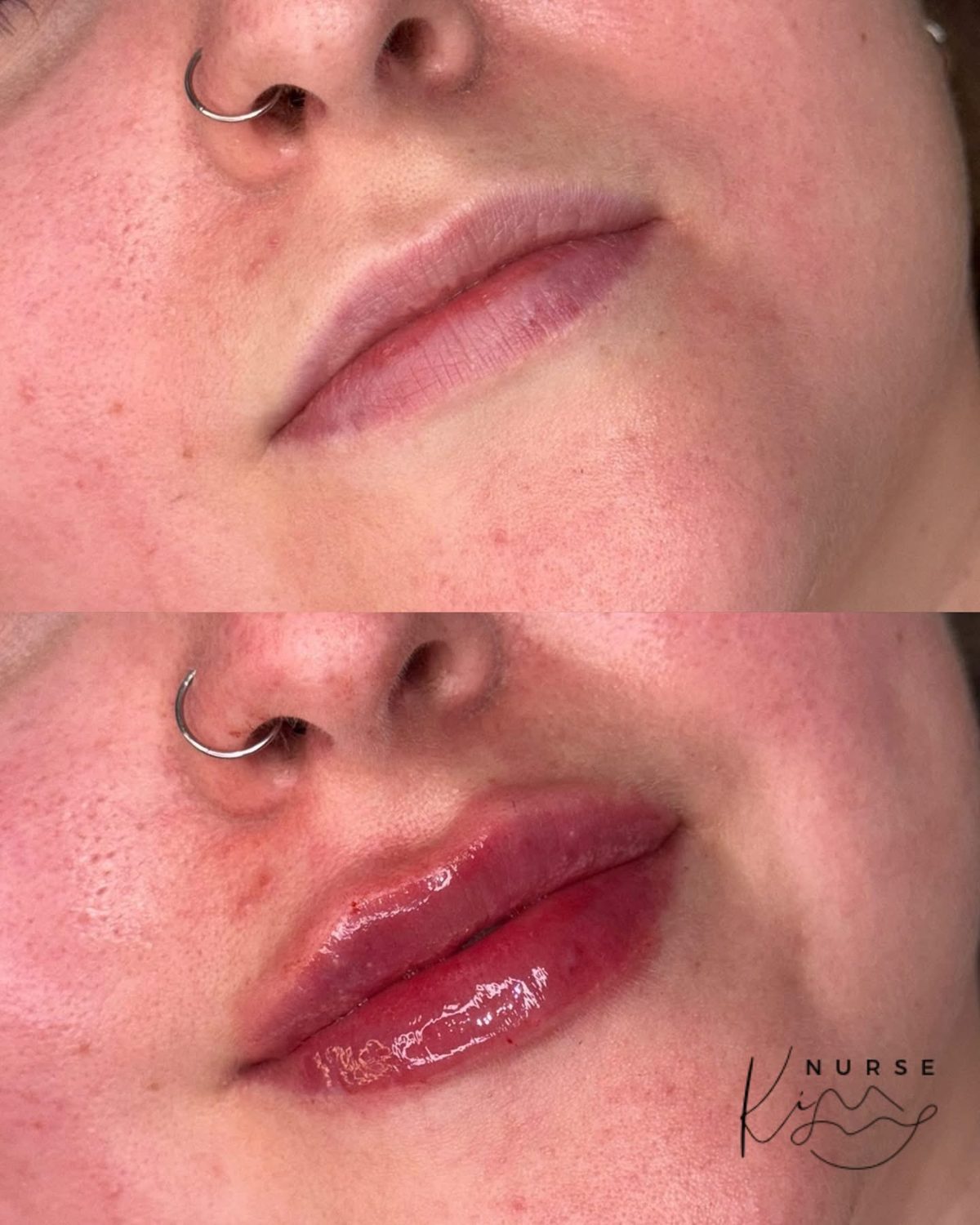 Lip Filler result