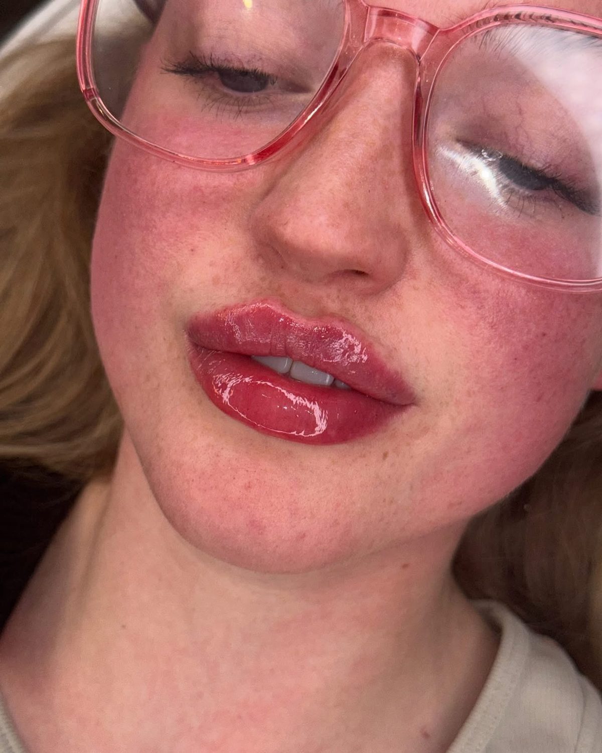 Lip Filler result