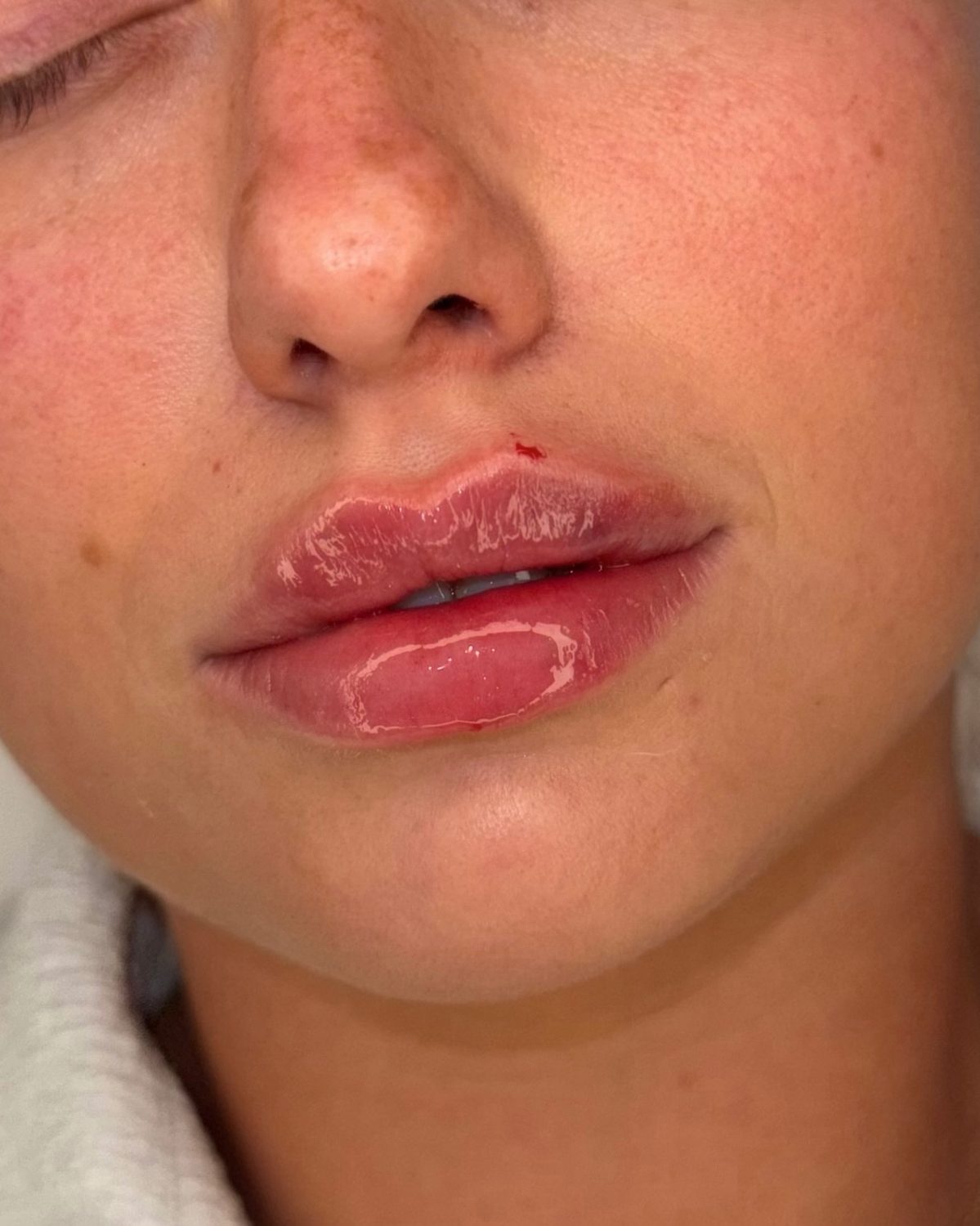 Lip Filler result