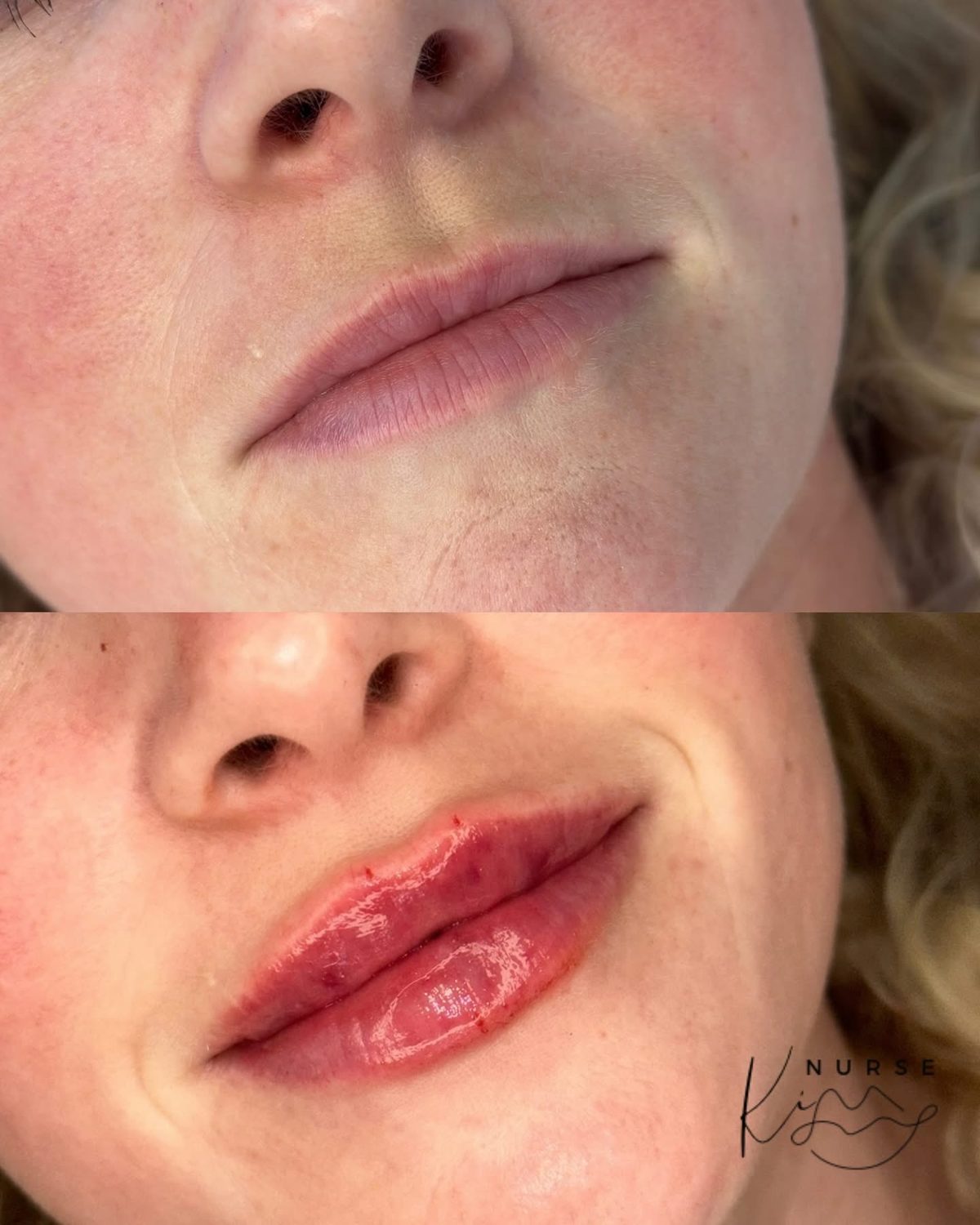 Lip Filler result