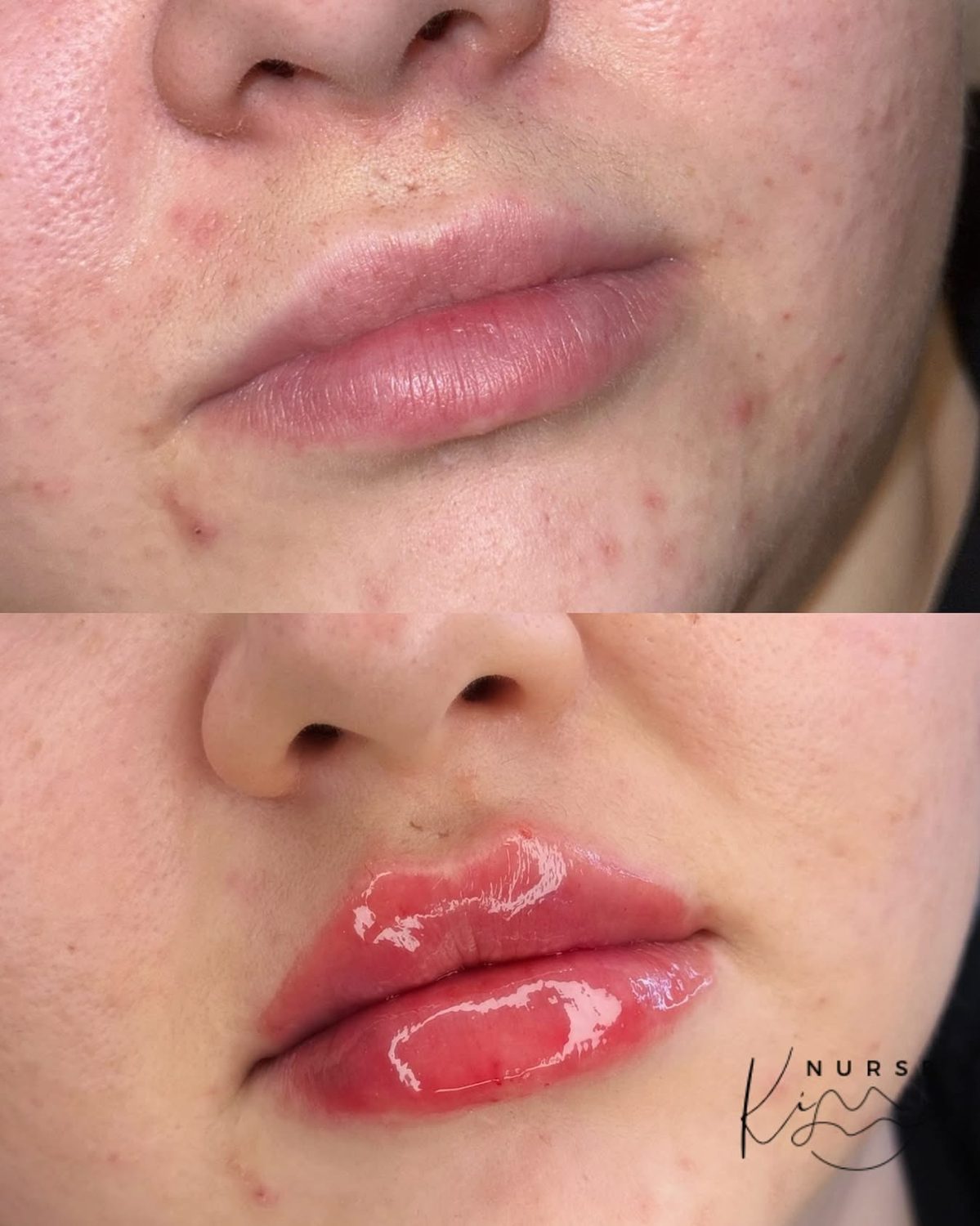 Lip Filler result