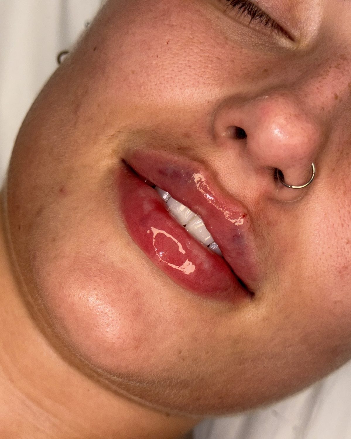 Lip Filler result