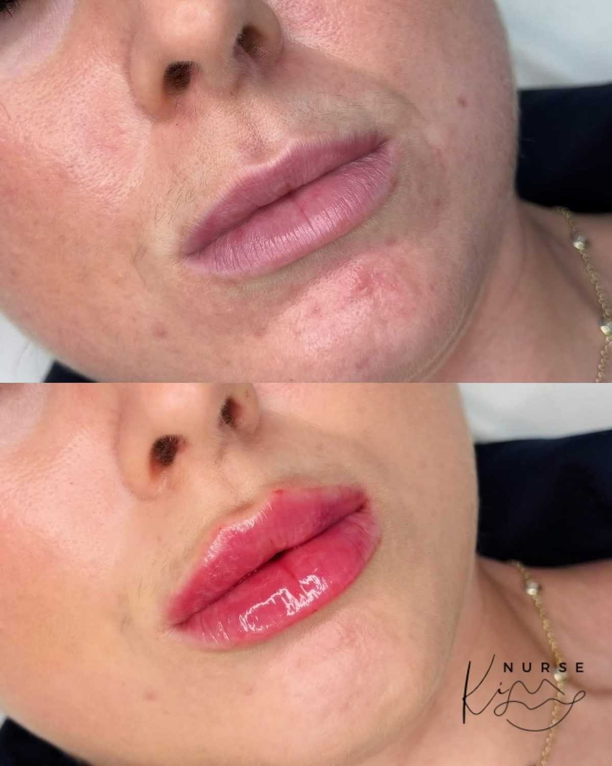 Lip Filler result