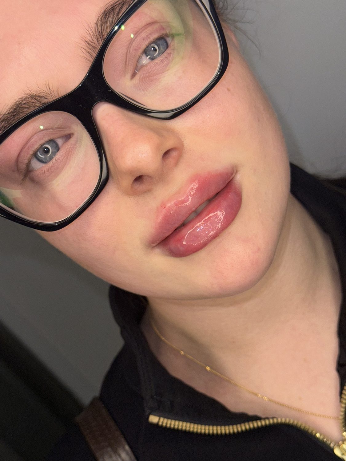 Lip Filler result