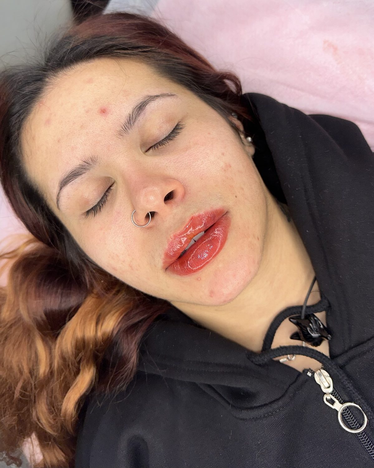 Lip Filler result