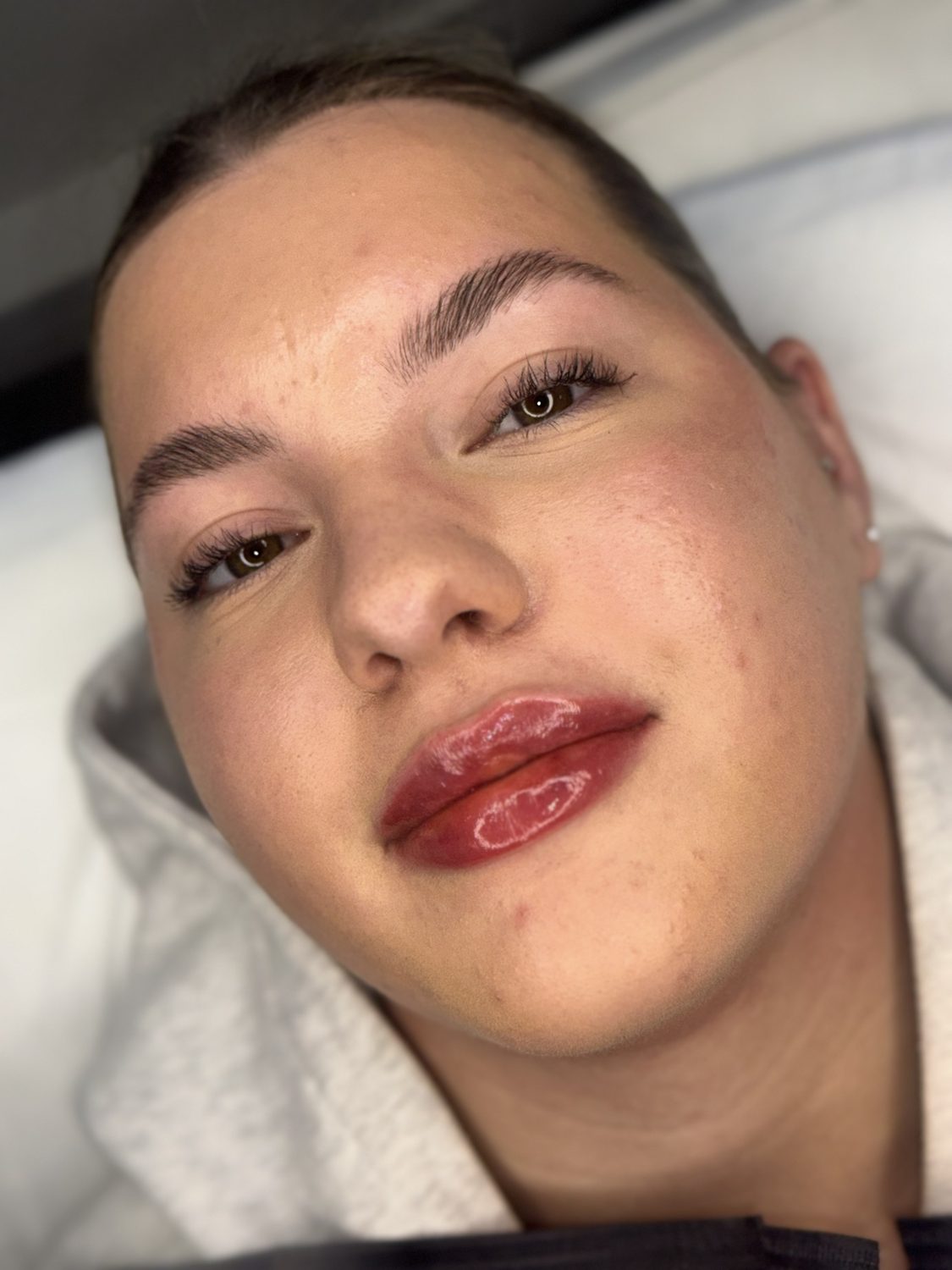 Lip Filler result