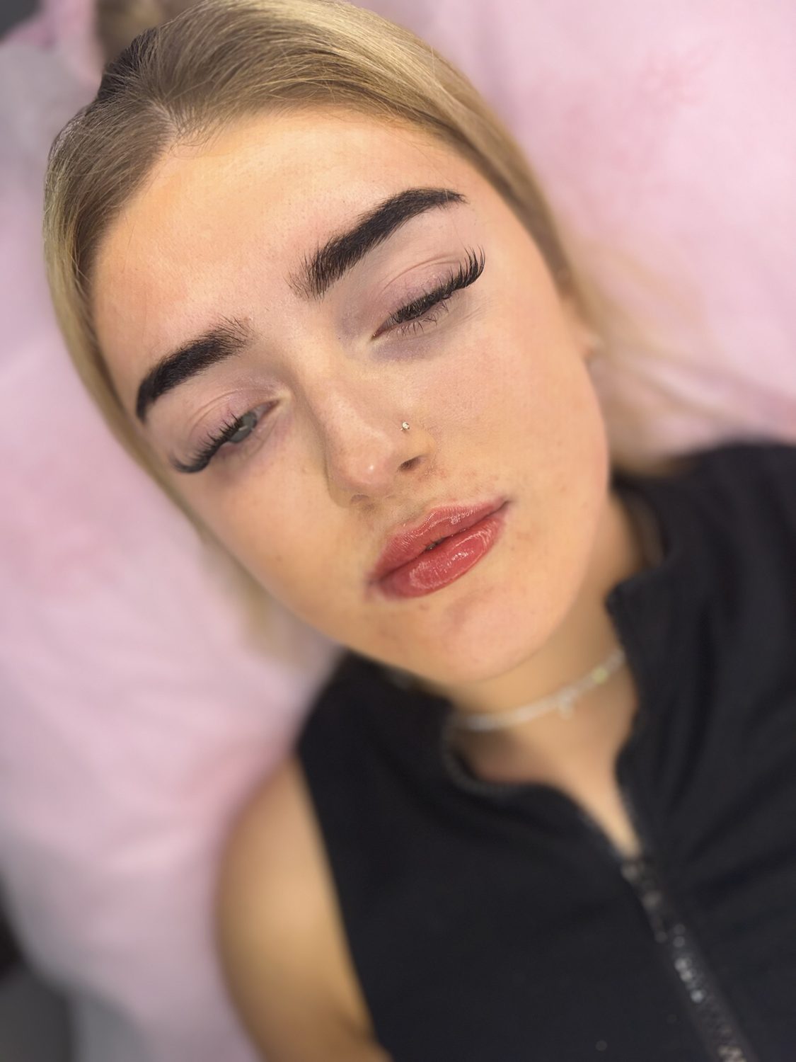 Lip Filler result