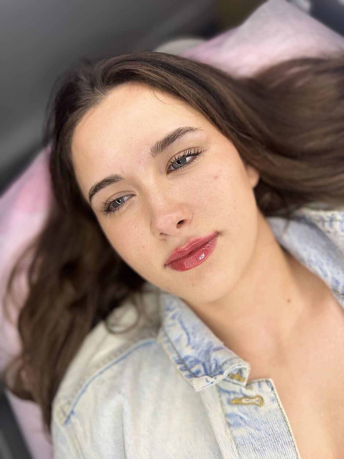 Lip Filler result