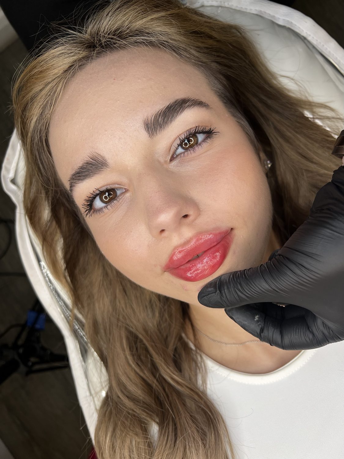 Lip Filler result