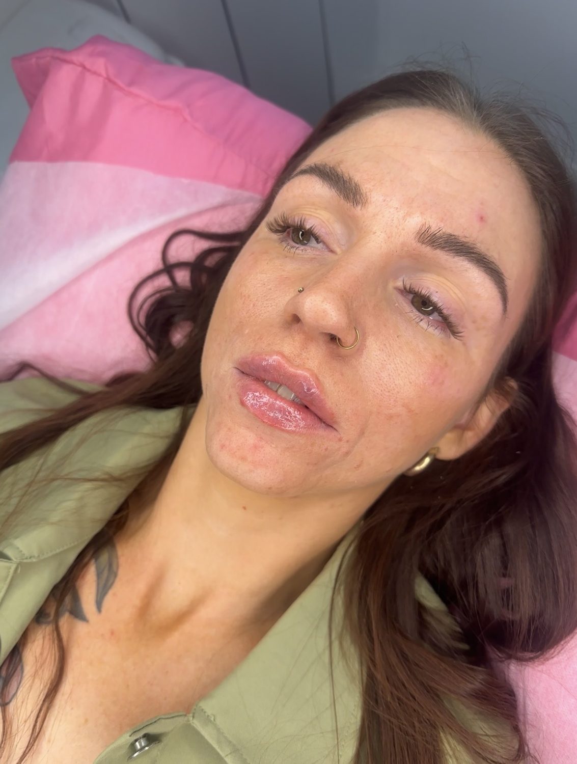 Lip Filler result