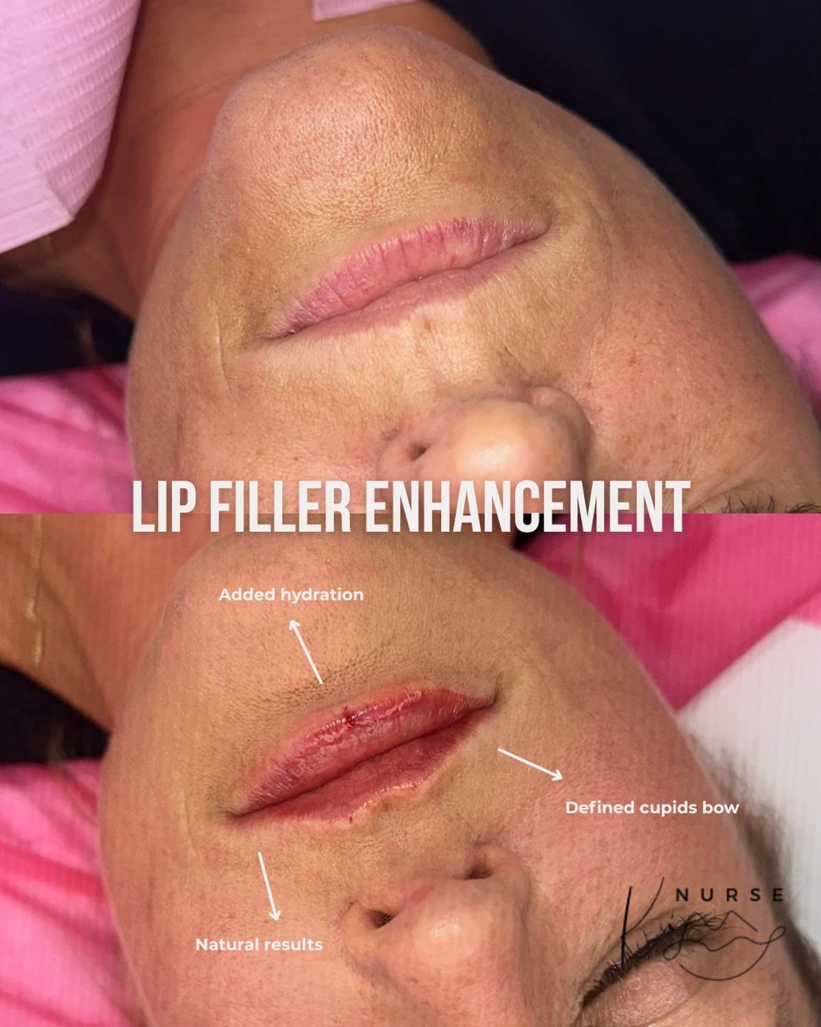 Lip Filler result