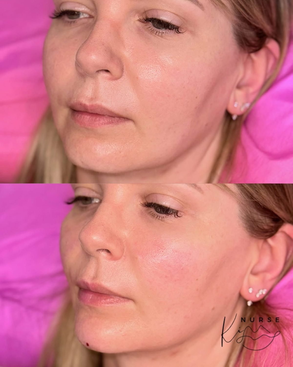 Chin Filler result
