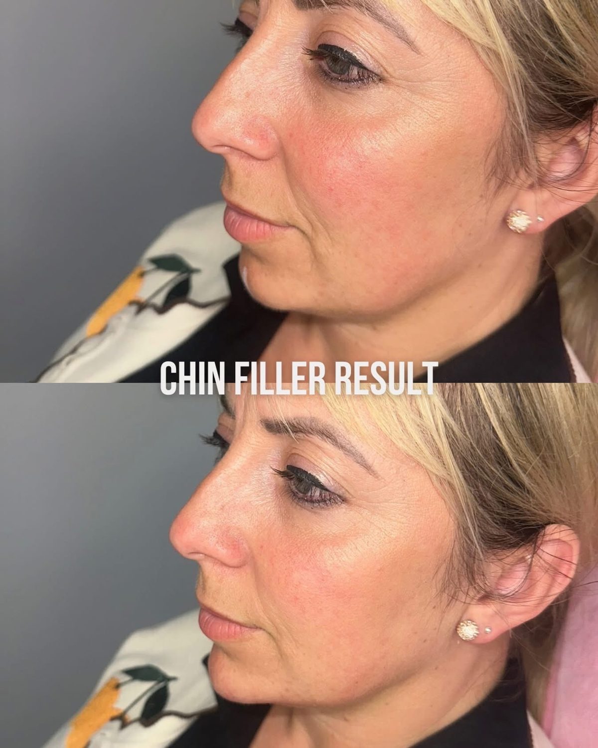 Chin Filler result
