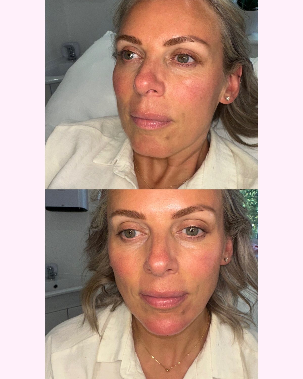 Chin Filler result