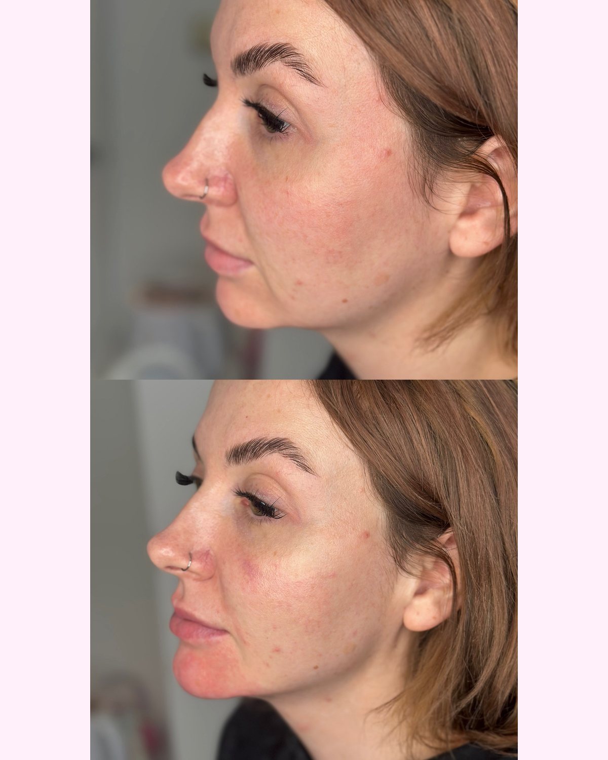 Chin Filler result