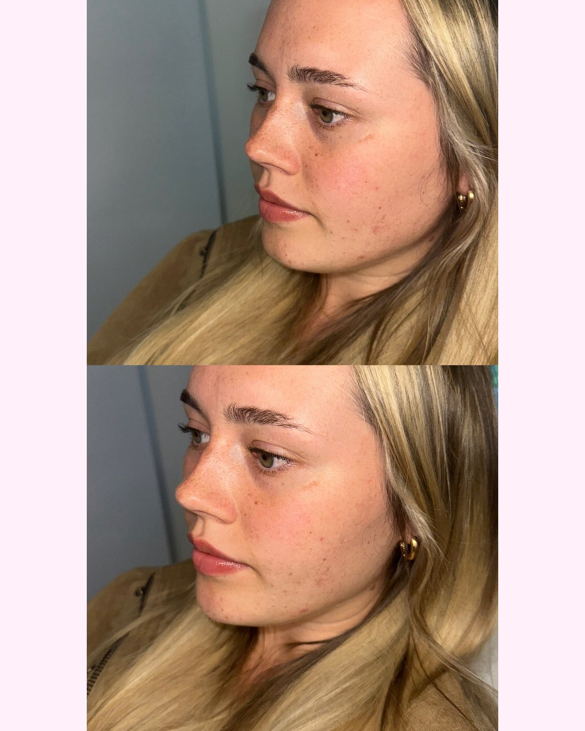 Chin Filler result