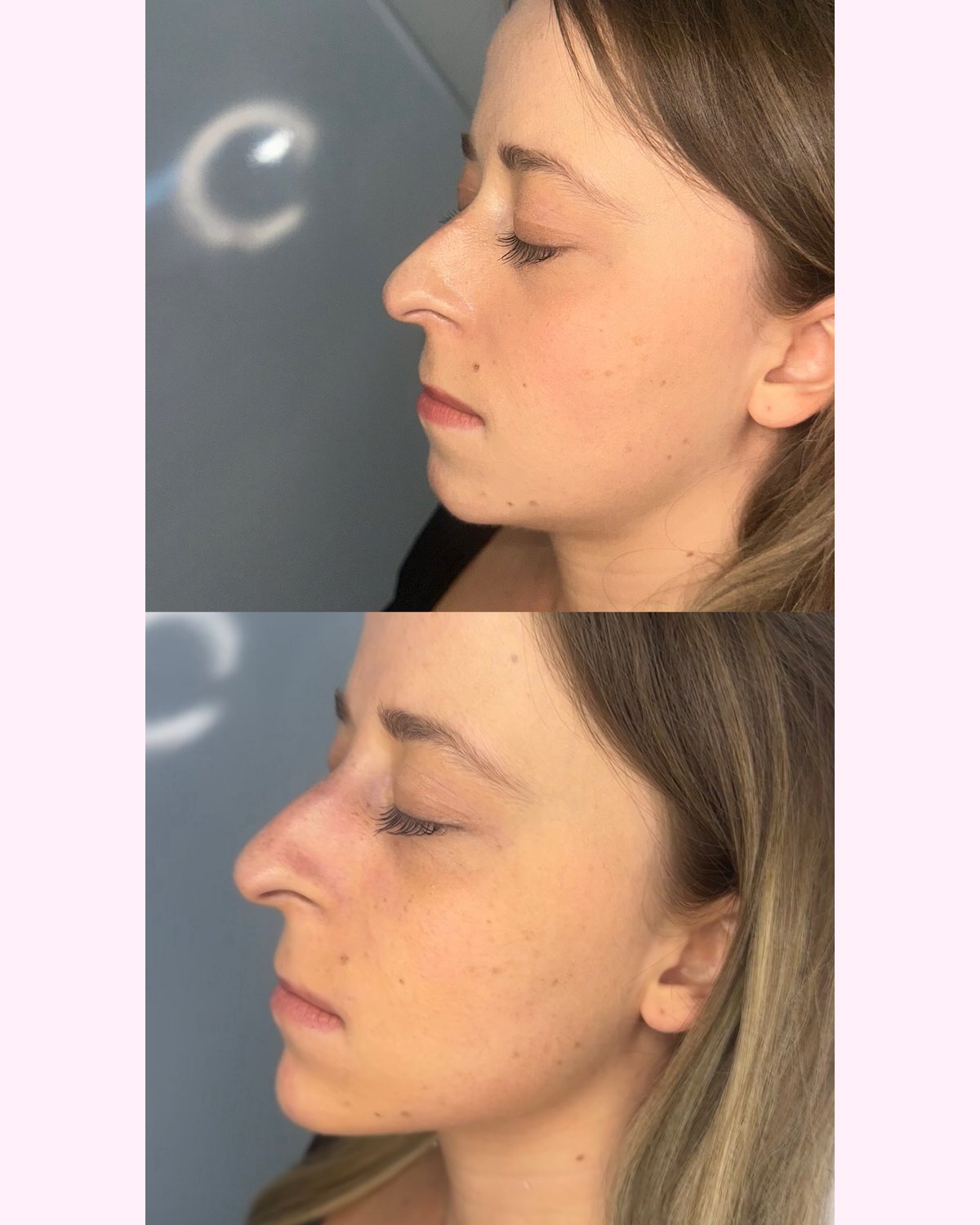 Chin Filler result
