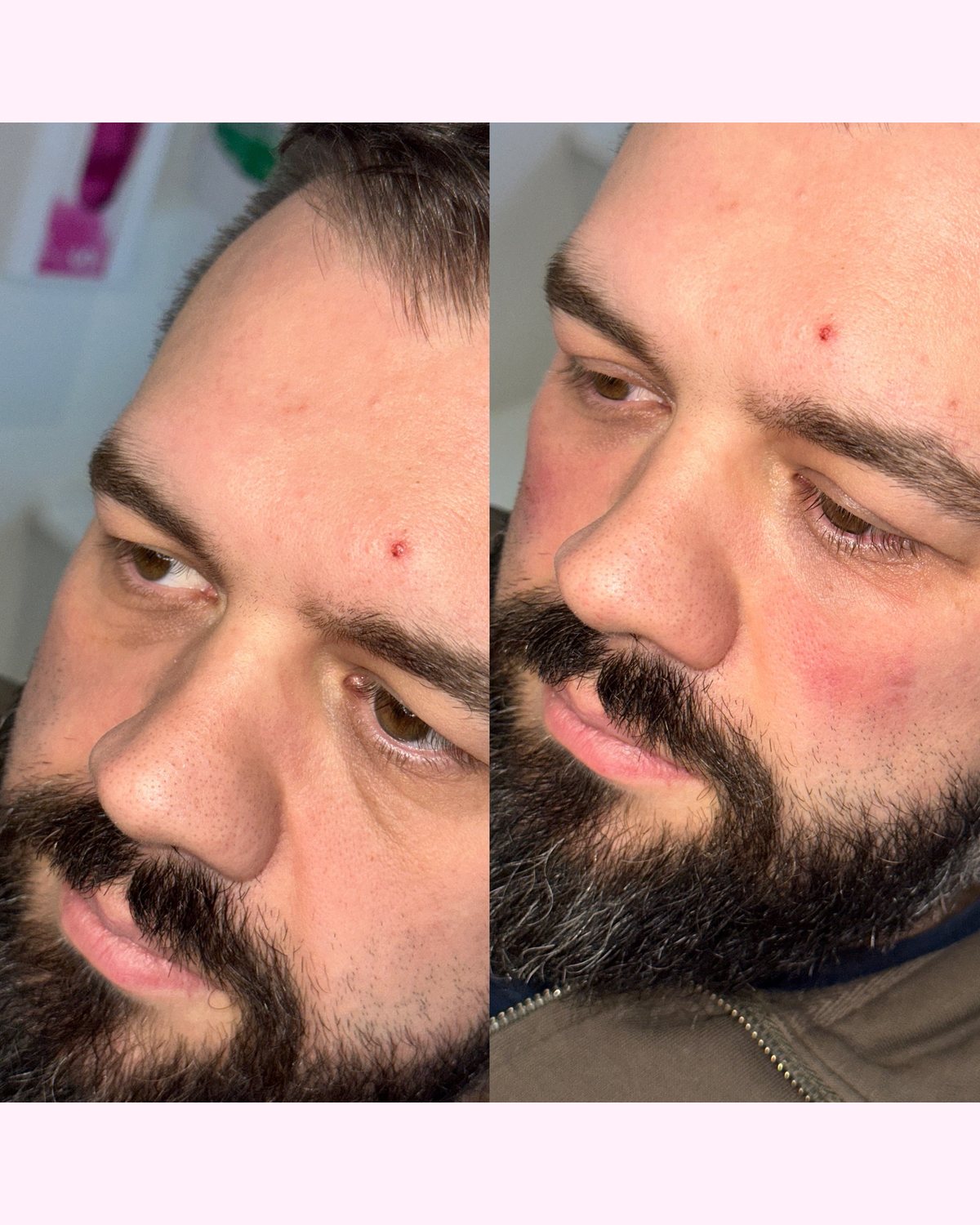 Under eye skin boosters result