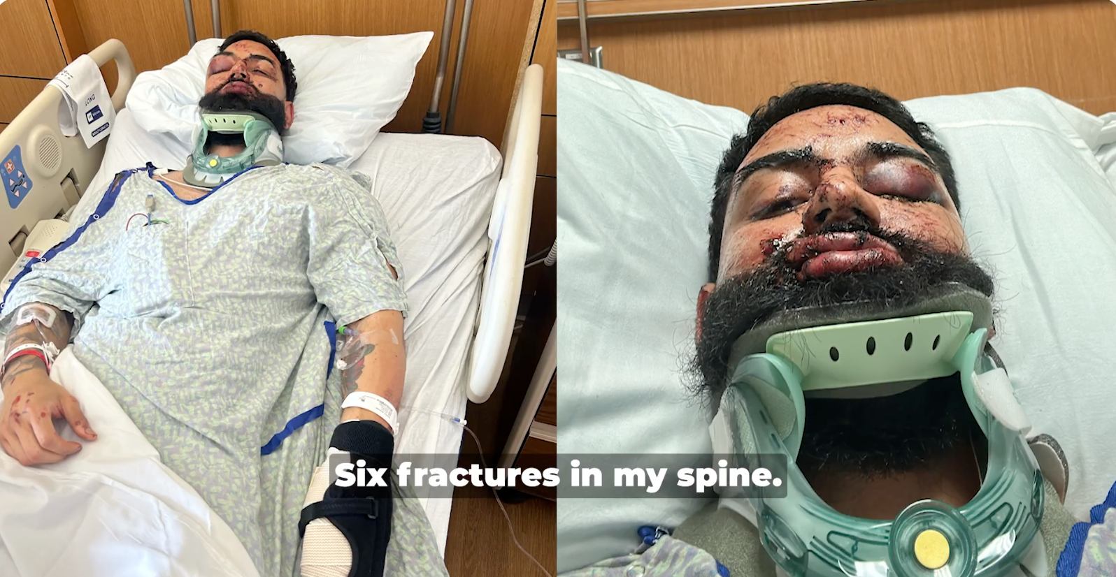 Six fractures in my spine