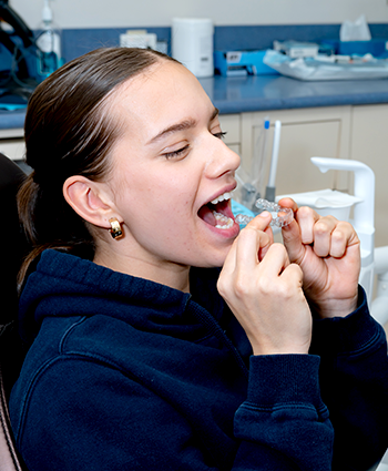 Invisalign Clear Aligners