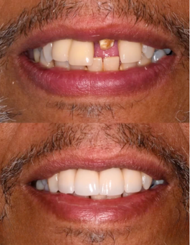 Smile Makeover All on Four