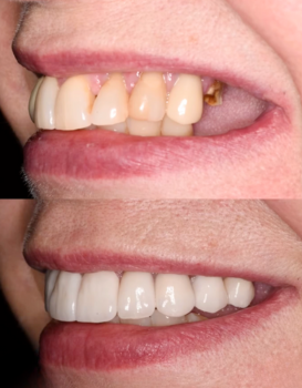 Smile Makeover Permanent Denture