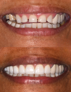 Smile Makeover Implant Denture
