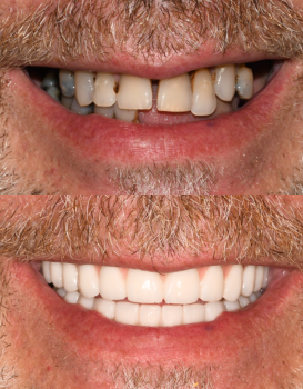 Smile Makeover Single Implants