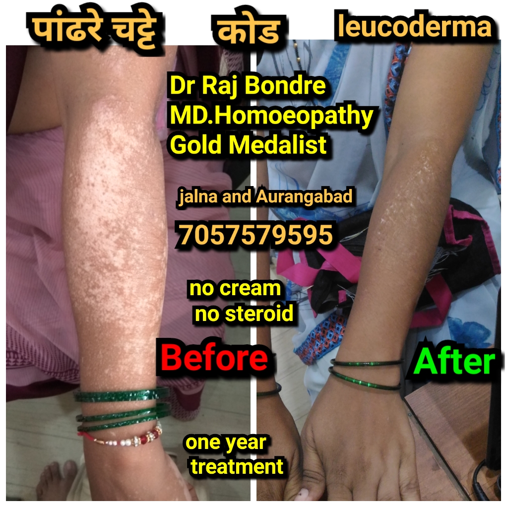 Warts before and after