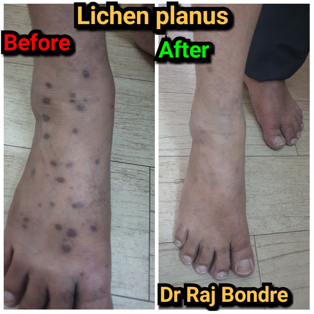 Lichen planus before and after