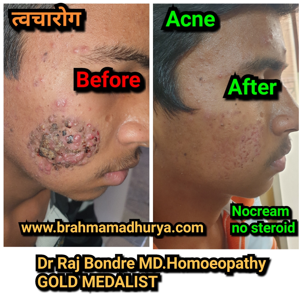 Pimples before and after