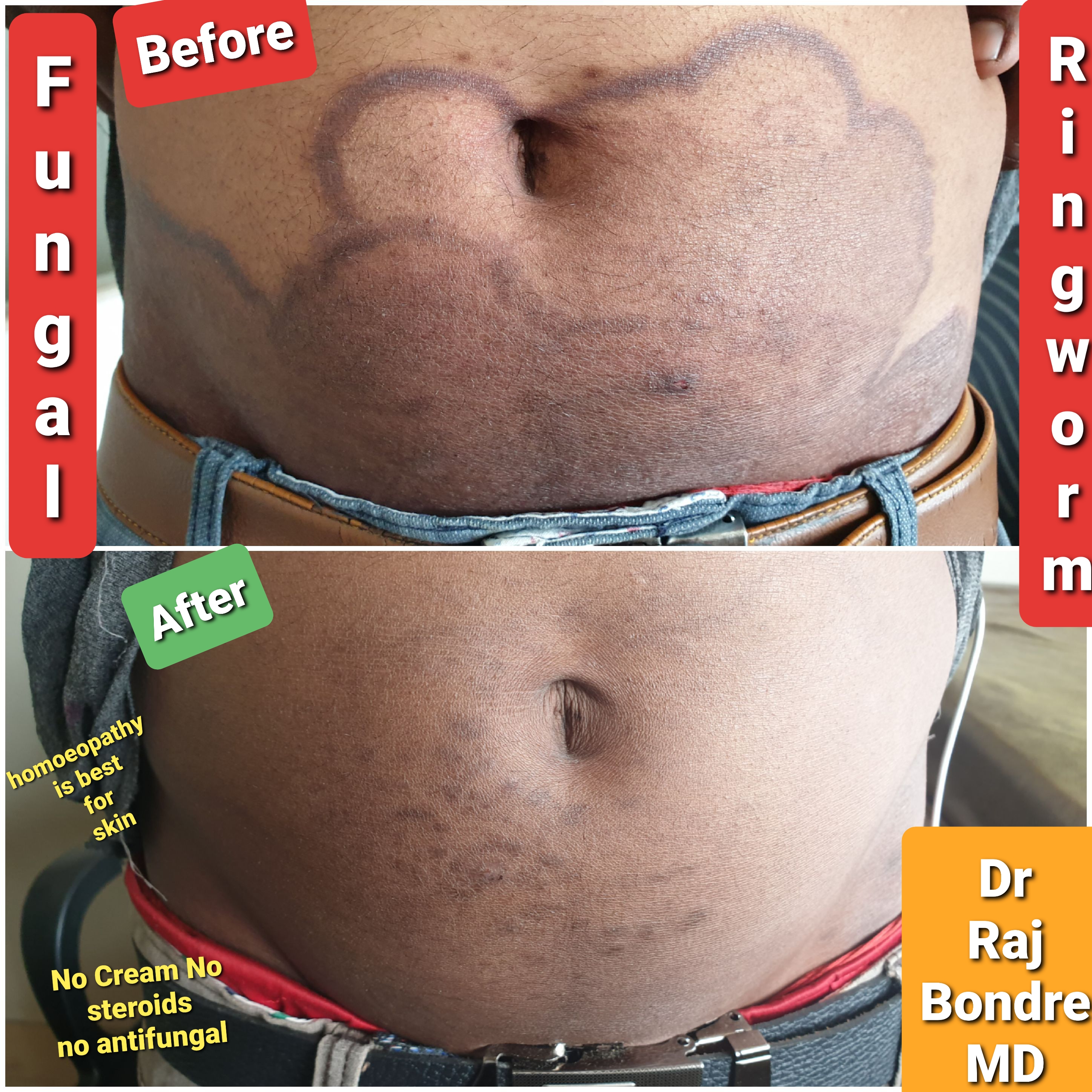 Fungal infection before and after