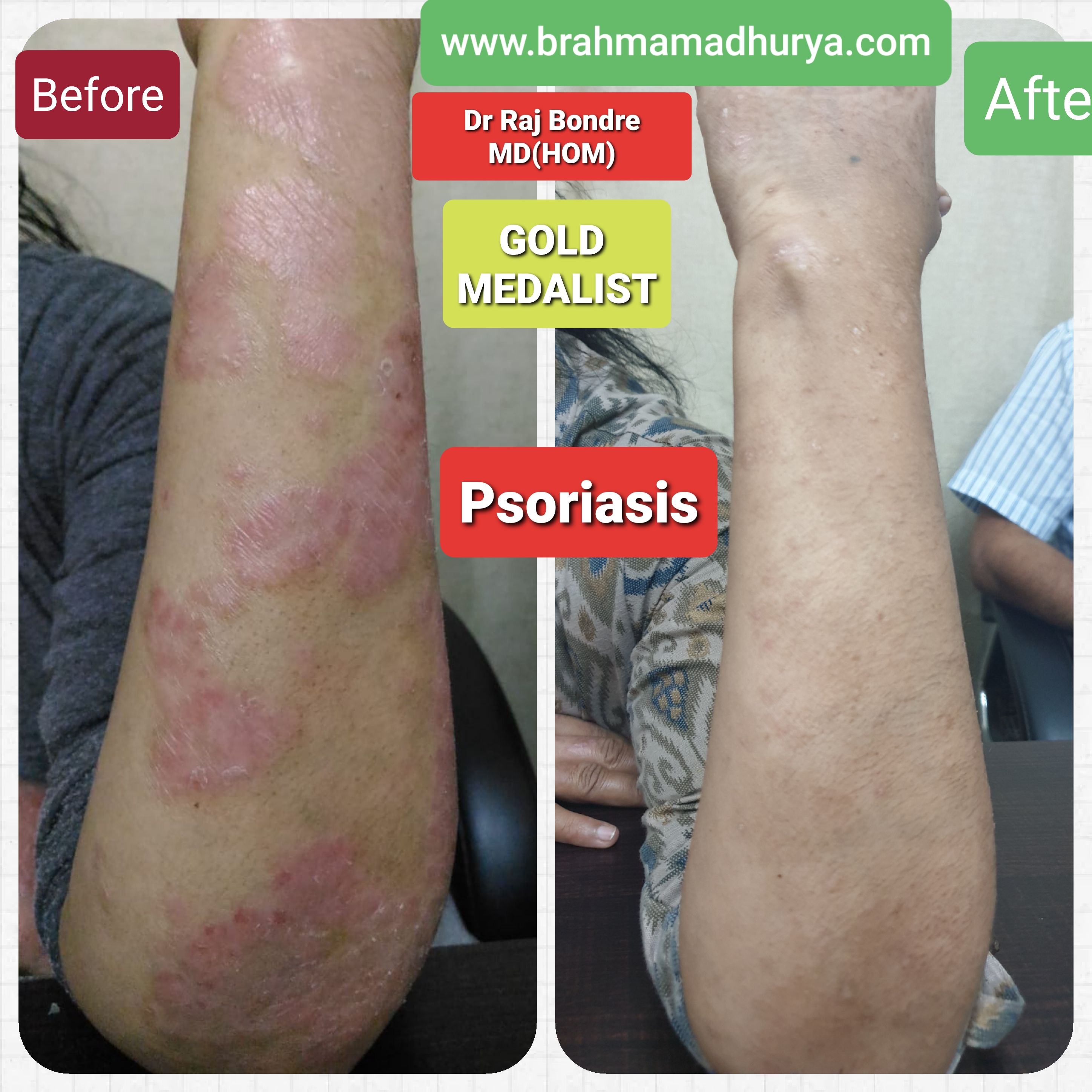 Psoriasis result