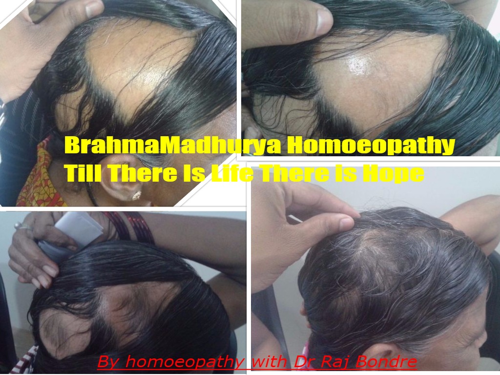 Alopecia before and after