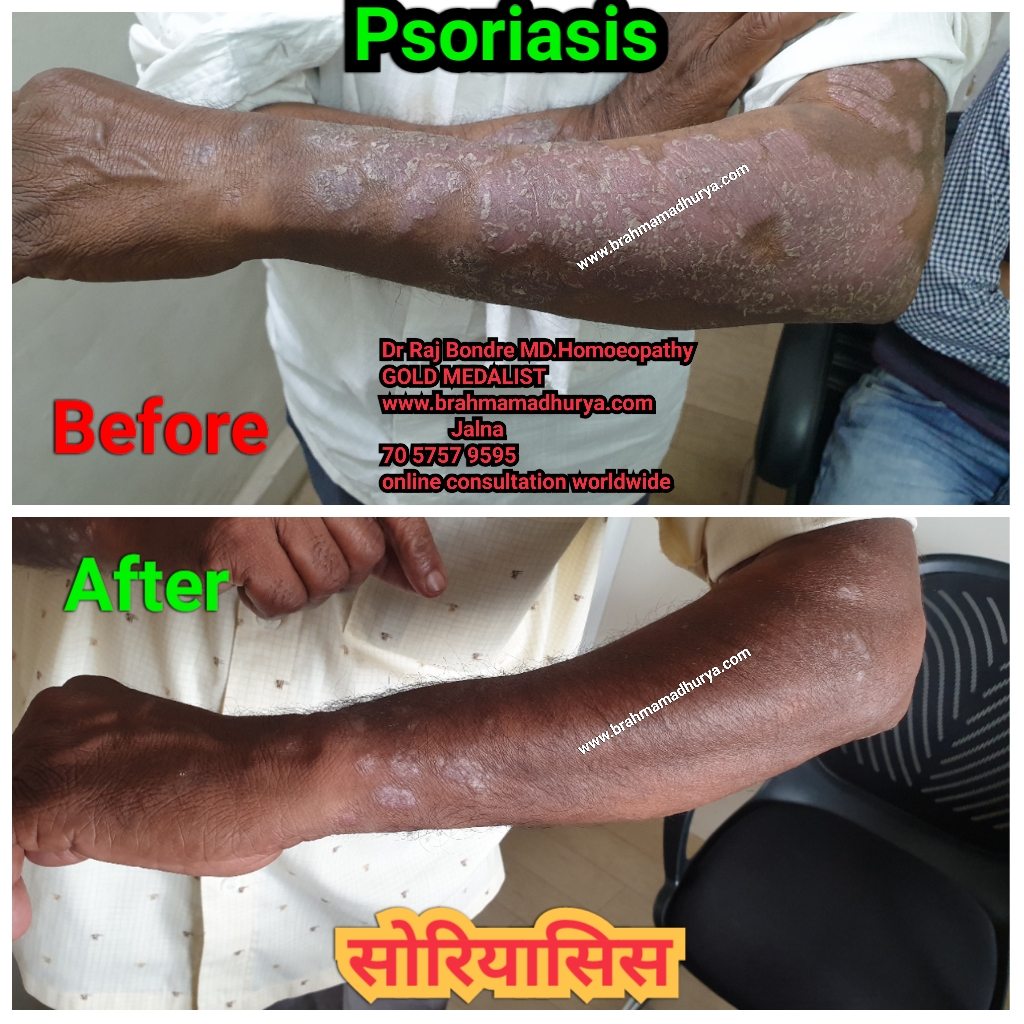 Psoriasis before and after