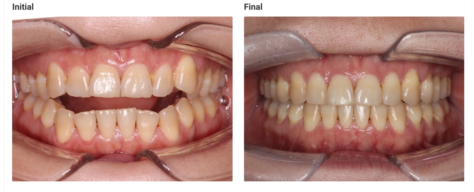Invisalign before and after - gaps closed