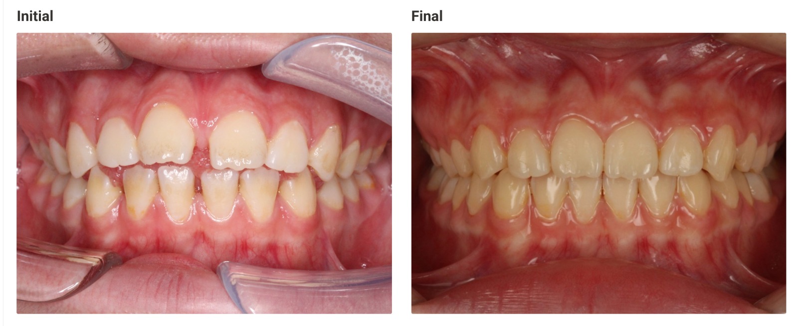 Invisalign before and after - crowding corrected