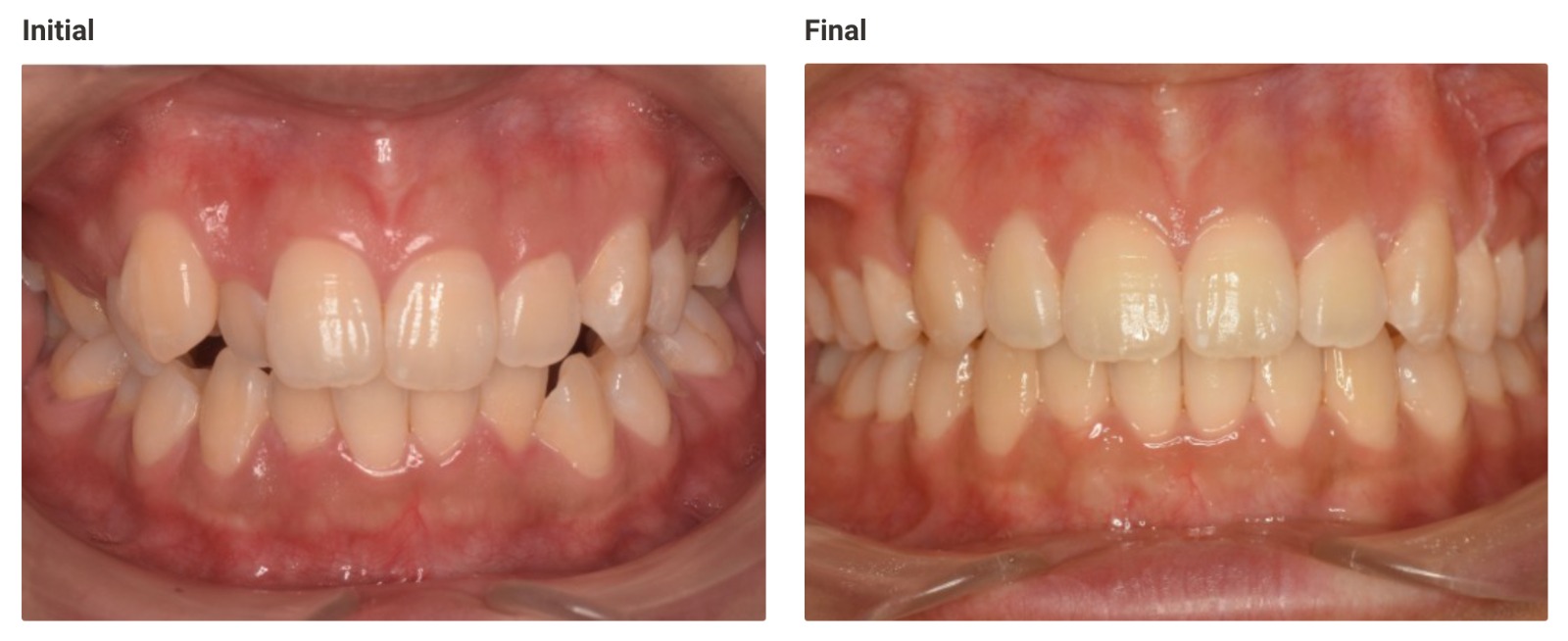Invisalign before and after - straighter smile