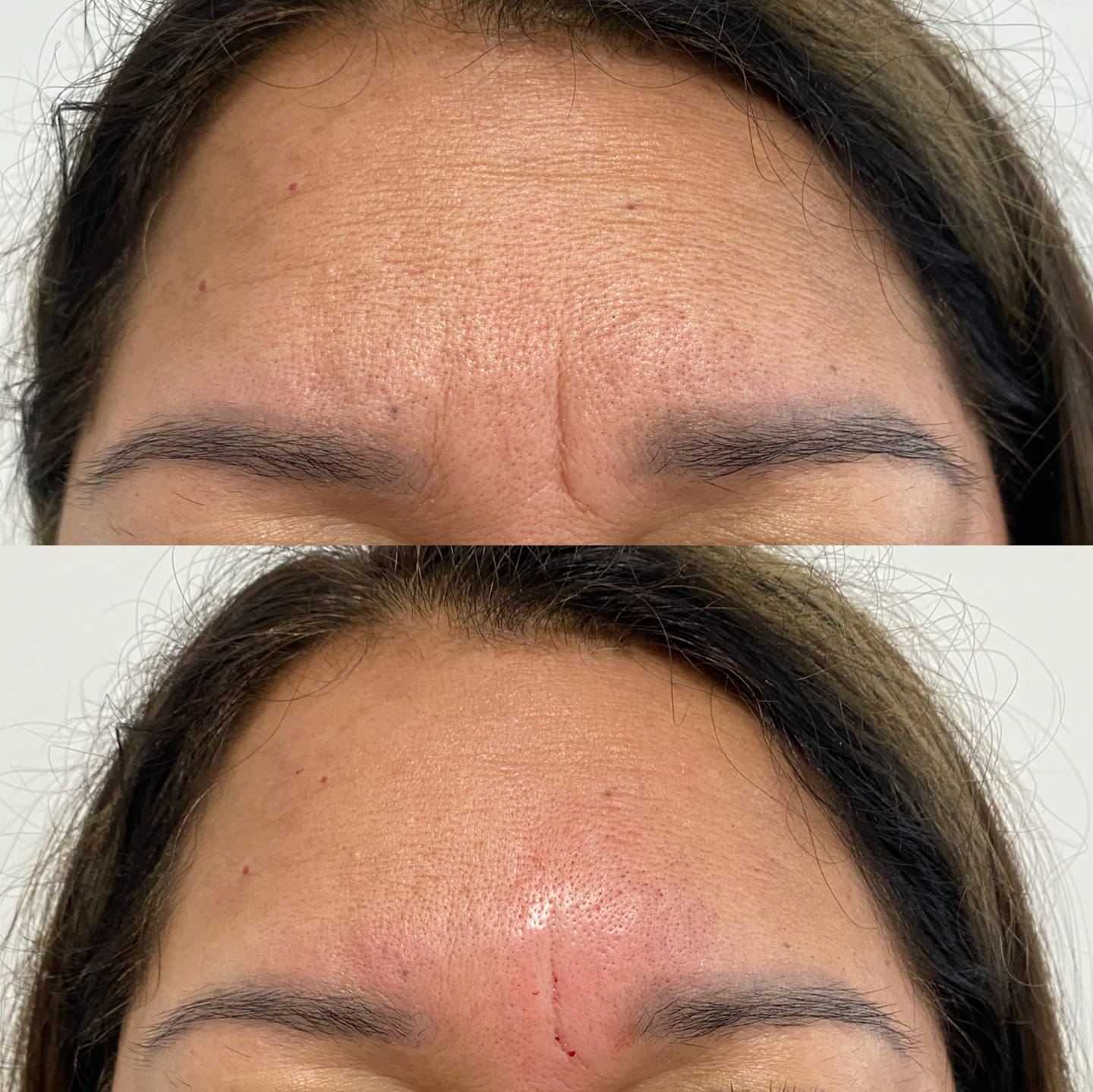 Botox before and after wrinkle reduction results