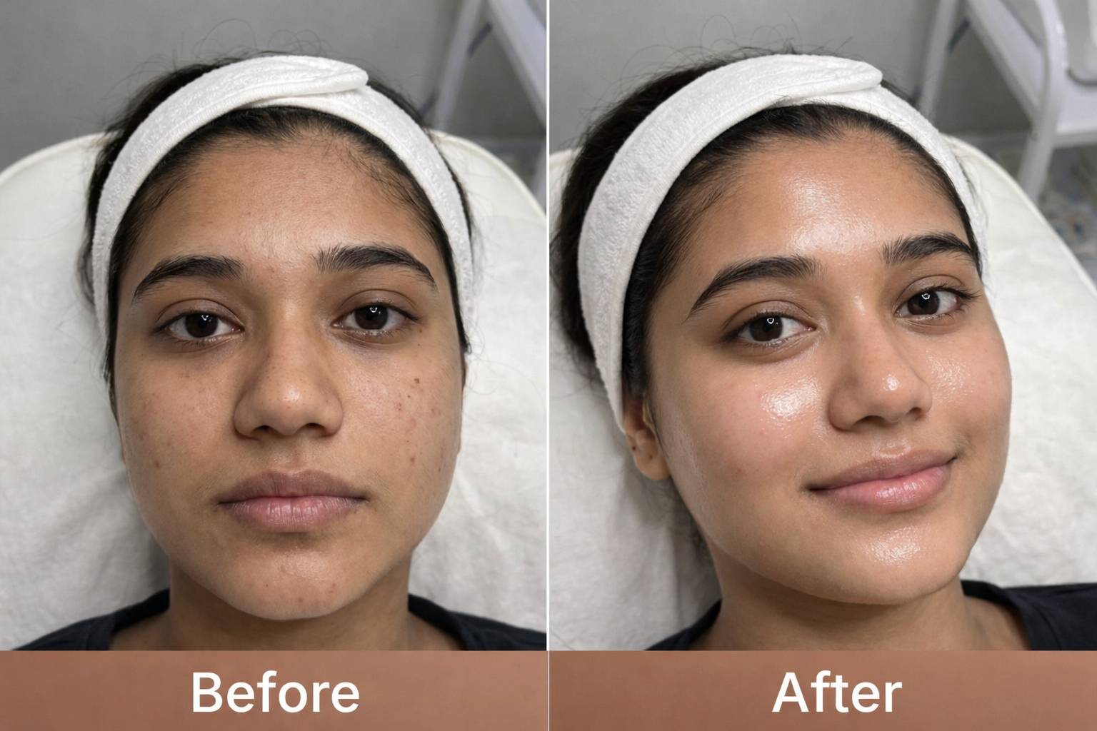 Before and after skin booster treatment results