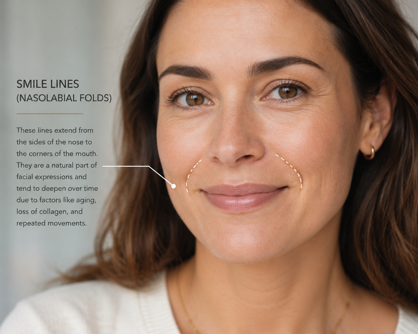 Woman in her 30s noticing smile lines and nasolabial folds Woman in her 30s noticing smile lines and nasolabial folds