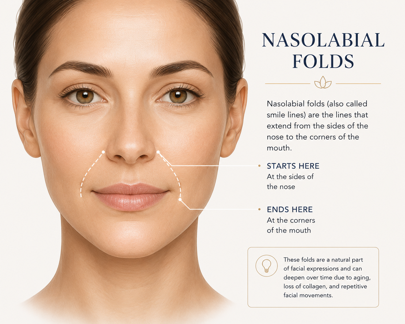 Facial illustration showing where nasolabial folds and smile lines appear Facial illustration showing where nasolabial folds and smile lines appear