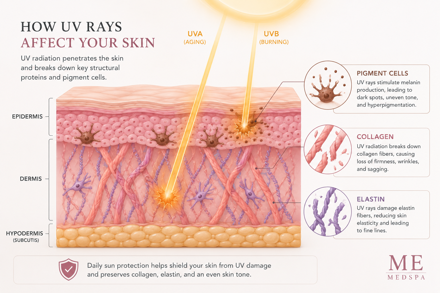 Illustration showing ultraviolet rays contributing to photoaging within the skin