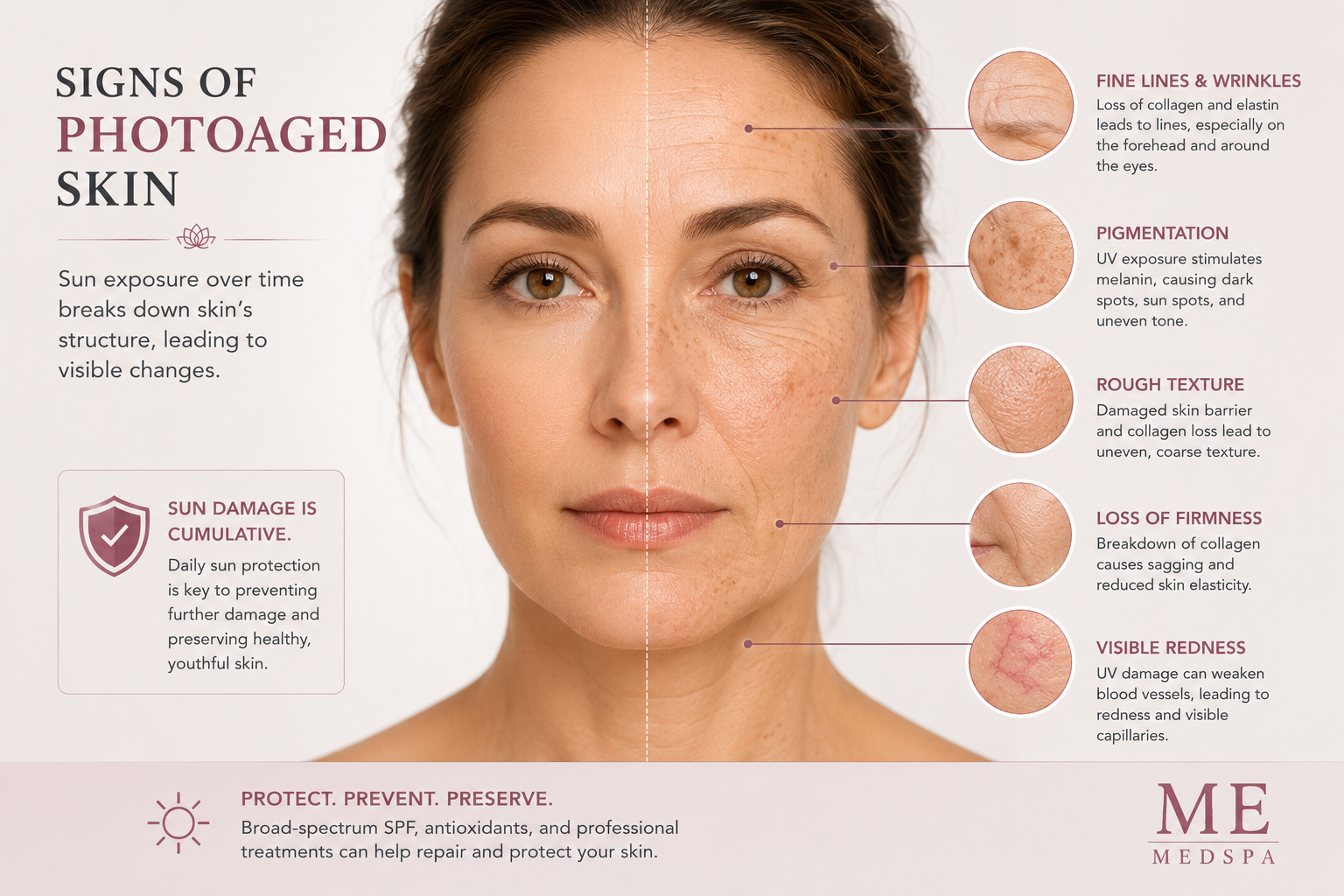 Illustration showing common visible signs of photoaging on the face