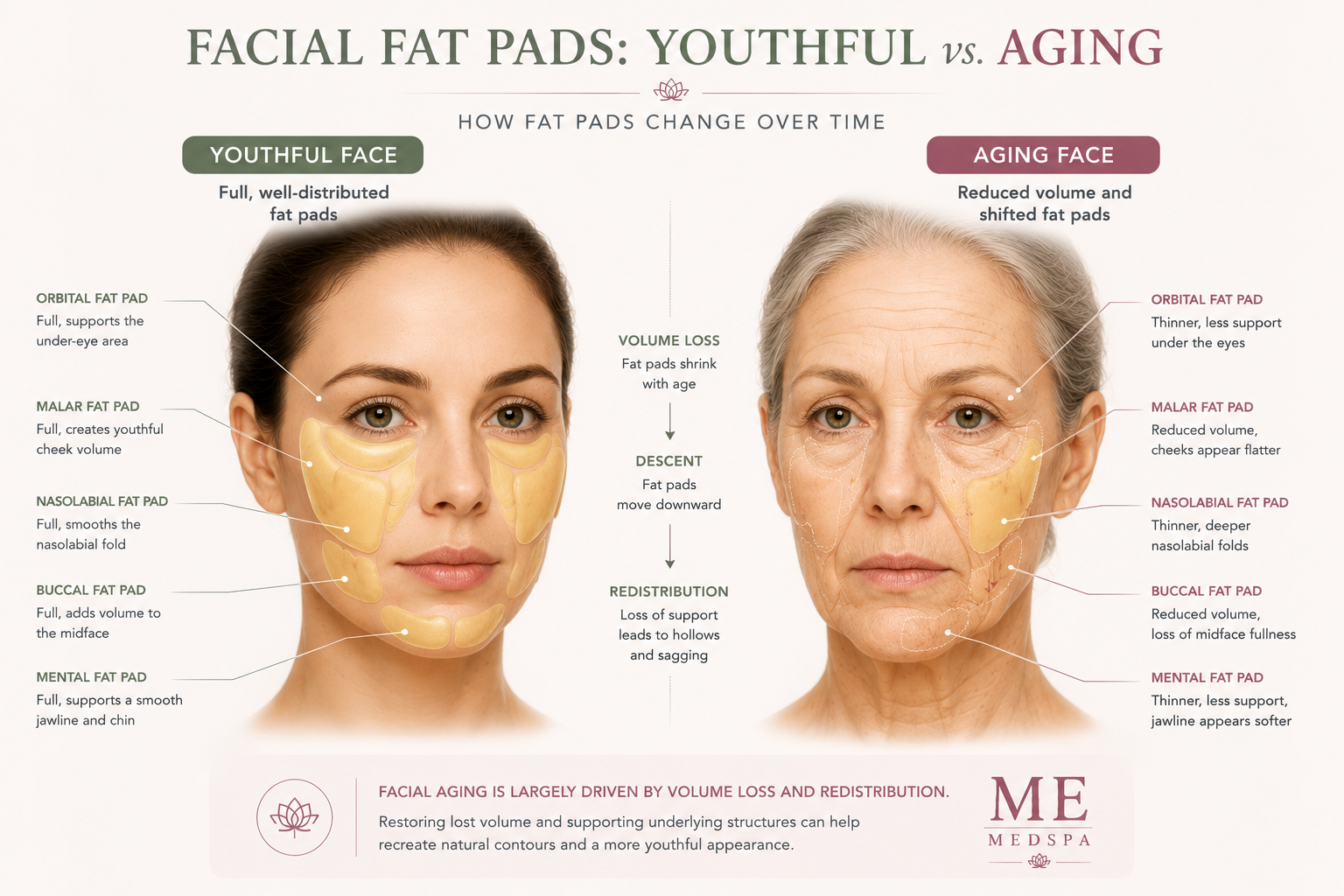 Illustration comparing youthful facial fat pads with age-related facial volume loss