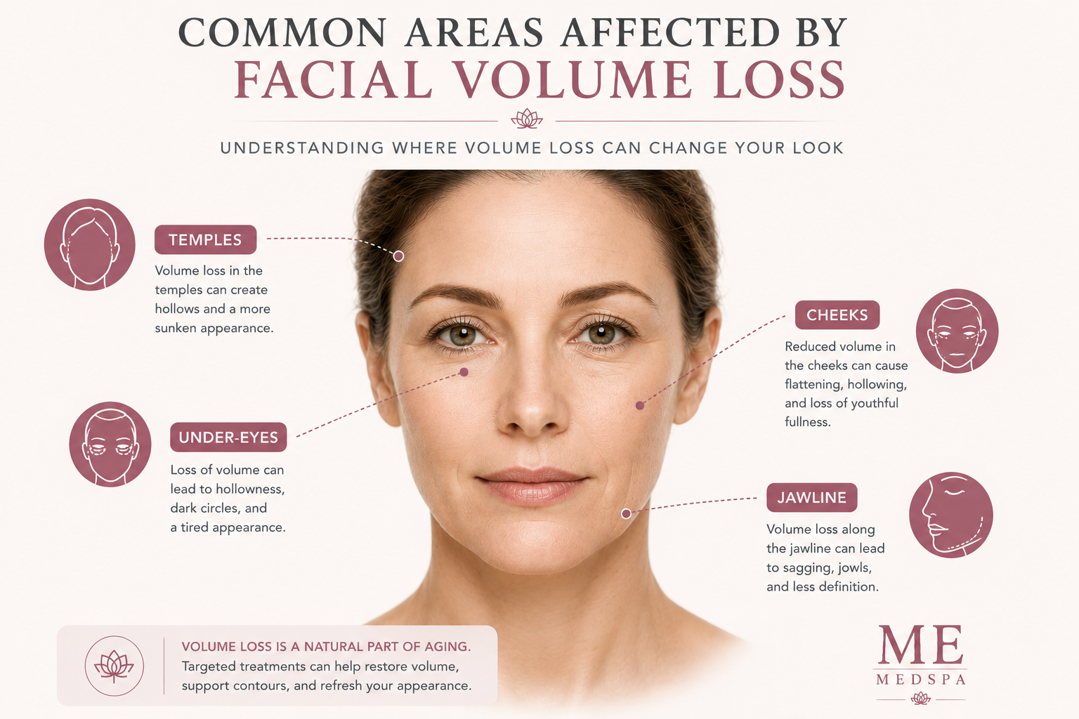Illustration showing common signs of age-related facial volume loss