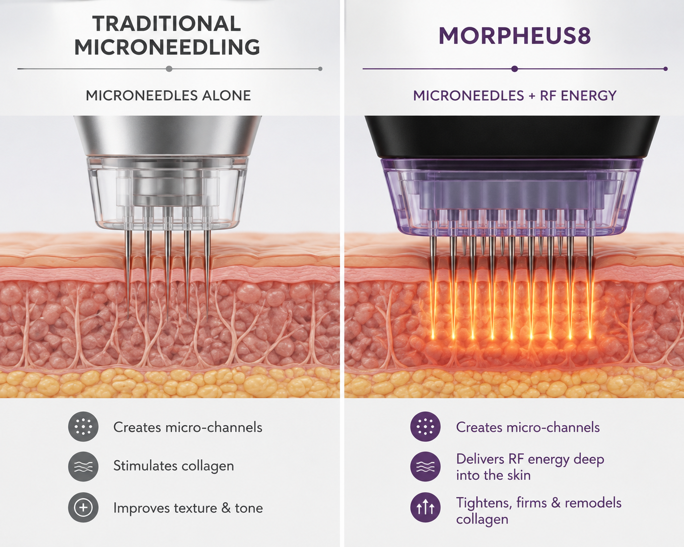 Comparison of traditional microneedling and Morpheus8 radiofrequency microneedling