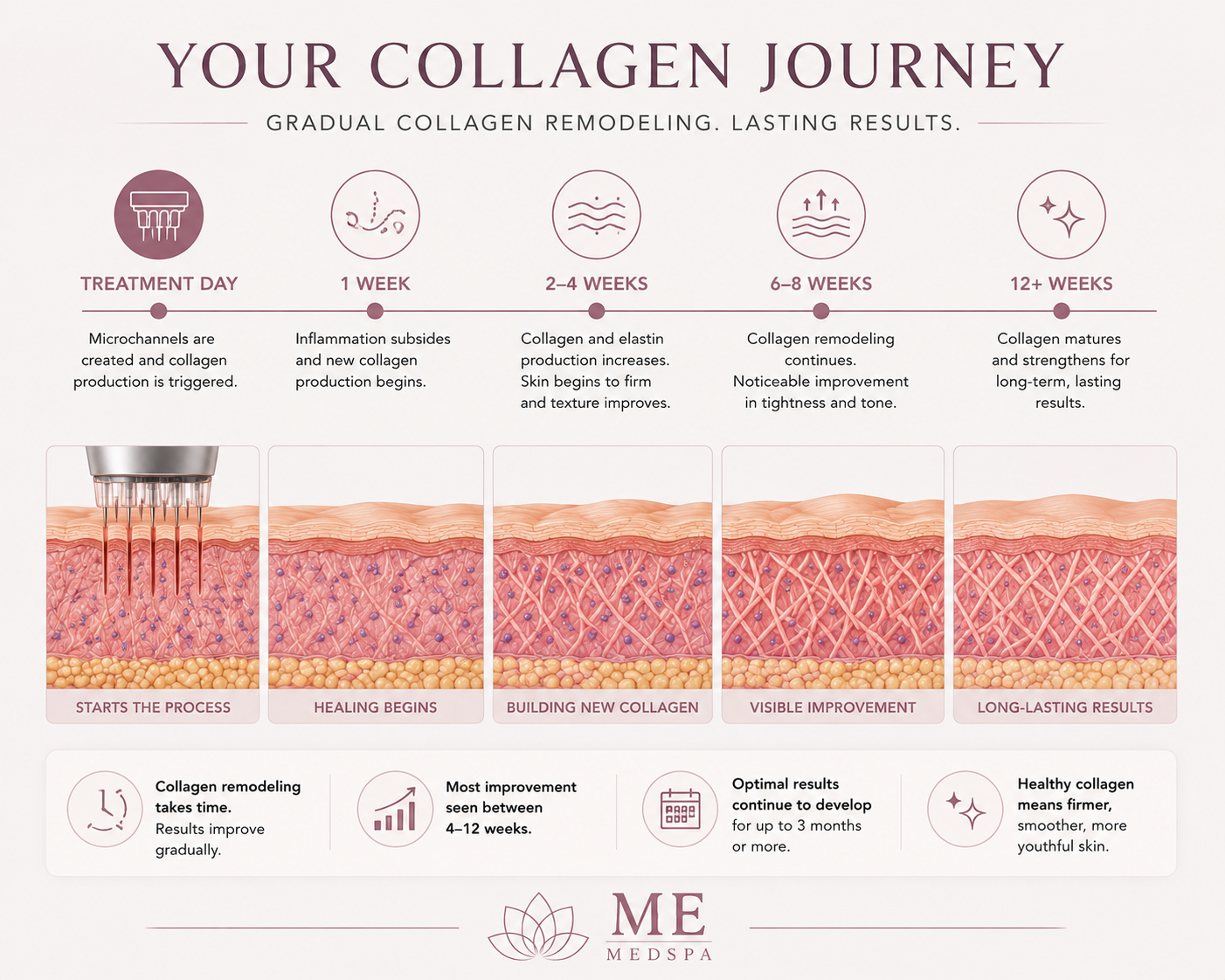 Illustration showing gradual collagen remodeling after microneedling and Morpheus8 treatments