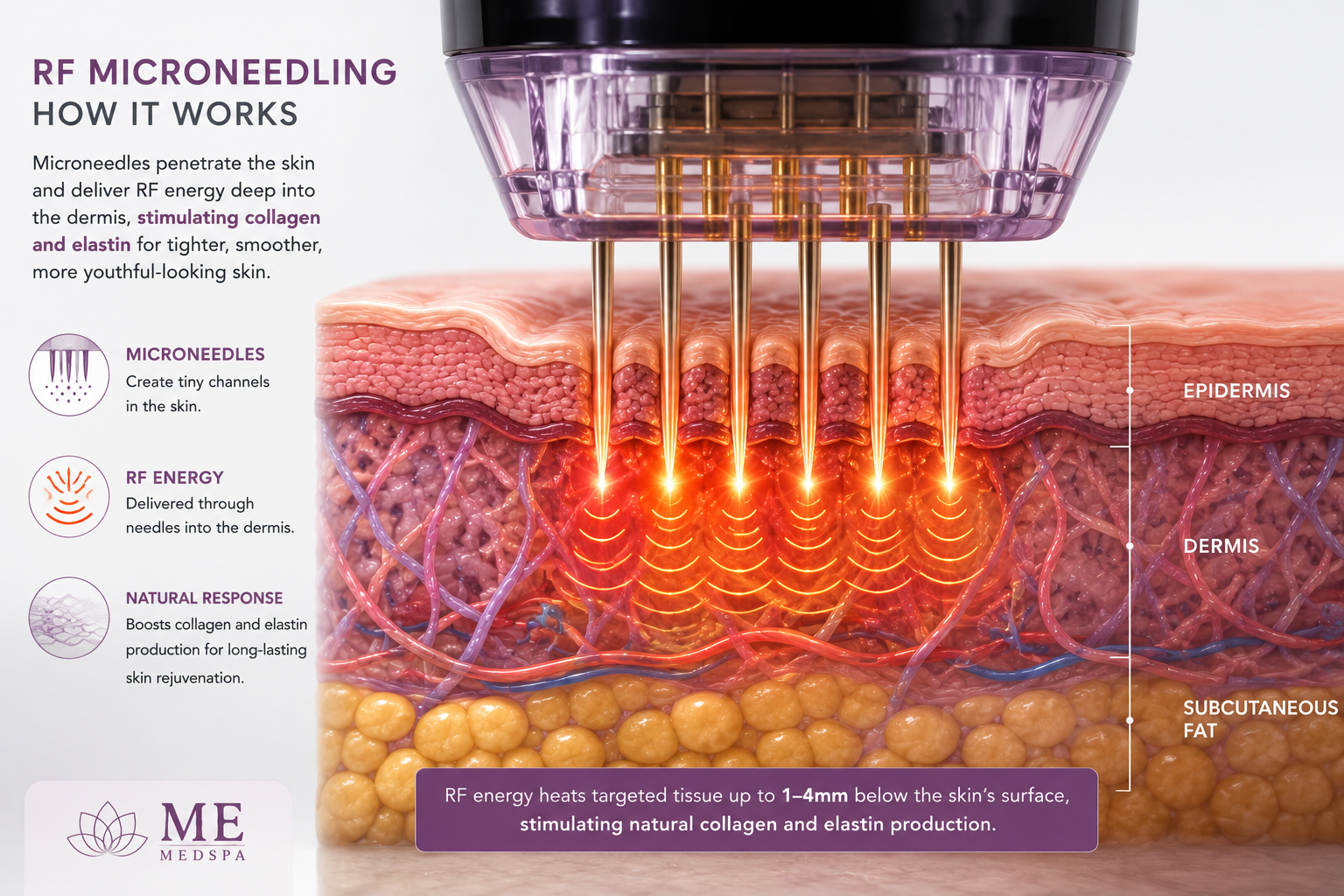Illustration showing Morpheus8 delivering radiofrequency energy beneath the skin